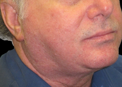 BTL_Exilis_System_PIC_022-After-eyes-male-William-Loverme-MD-3TX_412x296px_1589888580_original