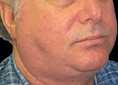 BTL_Exilis_System_PIC_022-Before-eyes-male-William-Loverme-MD_412x296px_1589888582_original