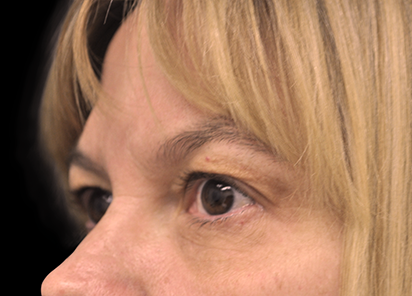 BTL_Exilis_Ultra_PIC_009-After-eyes-female-Jason-Lupton-MD-1TX_412x296px_1589889290_original