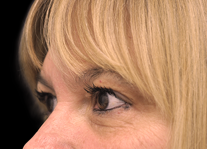 BTL_Exilis_Ultra_PIC_009-Before-eyes-female-Jason-Lupton-MD_412x296px_1589889292_original