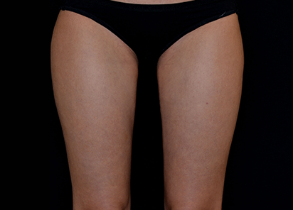 BTL_Vanquish_ME_Flex_PIC_025-After-legs-female-BTL-Aesthetics-4TX_412x296_1589438438_original