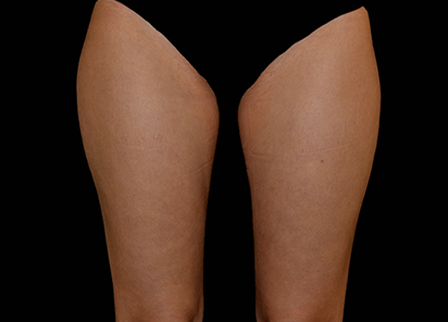 BTL_Vanquish_ME_Flex_PIC_025-Before-legs-female-BTL-Aesthetics_412x296_1589438440_original