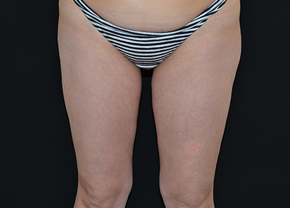 BTL_Vanquish_ME_Flex_PIC_026-After-legs-female-BTL-Aesthetics-4TX_412x296_1589438442_original