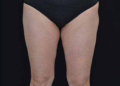 BTL_Vanquish_ME_Flex_PIC_026-Before-legs-female-BTL-Aesthetics_412x296_1589438444_original