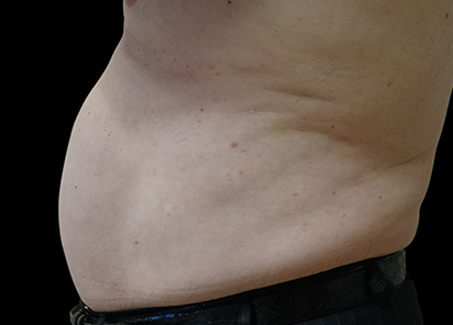 BTL_Vanquish_ME_PIC_068-After-abdomen-male-Grace-Liu-4TX_412x296_1589438282_original