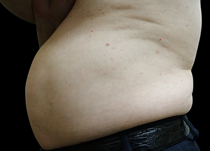 BTL_Vanquish_ME_PIC_068-Before-abdomen-male-Grace-Liu_412x296_1589438284_original