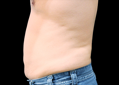 BTL_Vanquish_ME_PIC_088-After-abdomen-male-Suneel-Chilukuri-MD-4TX_412x296_1589438286_original