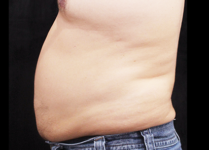 BTL_Vanquish_ME_PIC_088-Before-abdomen-male-Suneel-Chilukuri-MD_412x296_1589438288_original