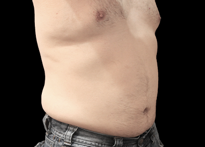 BTL_Vanquish_ME_PIC_090-After-abdomen-male-Suneel-Chilukuri-MD-4TX_412x296_1589438289_original