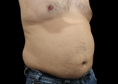 BTL_Vanquish_ME_PIC_090-Before-abdomen-male-Suneel-Chilukuri-MD_412x296_1589438291_original