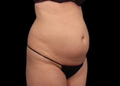 BTL_Vanquish_ME_PIC_112-Before-abdomen-female-Melanie-Palm-MD_412x296_1590145664_original