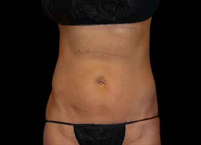 BTL_Vanquish_ME_PIC_113-After-abdomen-female-Amir-Moradi-MD-4TX_412x296_1590145667_original