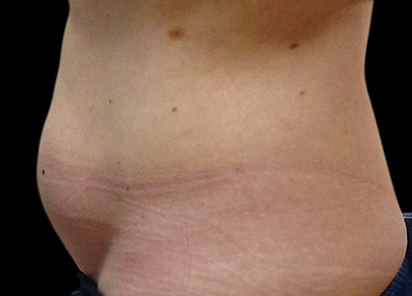 BTL_Vanquish_ME_PIC_117-Before-abdomen-female-Karen-Harkaway-MD_412x296_1590145675_original