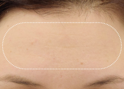 Emface_PIC_021-After-forehead-female-BTL-Aesthetics-3M_412x296px_1663830082_original