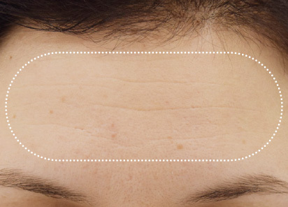 Emface_PIC_021-Before-forehead-female-BTL-Aesthetics_412x296px_1663830082_original