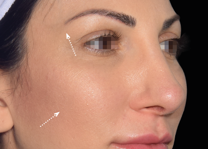 Emface_PIC_030-After-face-female-Yael-Halaas-MD-4TX_101_412x296px_1672383944_original