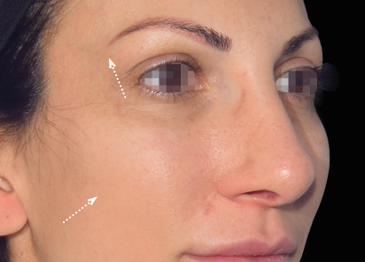 Emface_PIC_030-Before-face-female-Yael-Halaas-MD_101_412x296px_1672383929_original