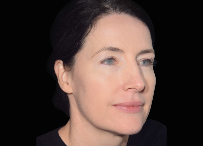 Emface_PIC_032-After-face-female-Yael-Halaas-MD-4TX_101_412x296px_1672383982_original