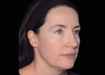 Emface_PIC_032-Before-face-female-Yael-Halaas-MD_101_412x296px_1672383964_original