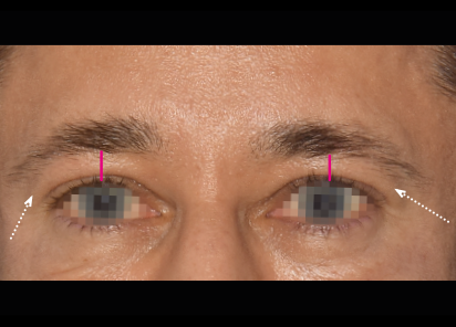 Emface_PIC_033-Before-forehead-male-Yael-Halaas-MD_101_412x296px_1672384218_original