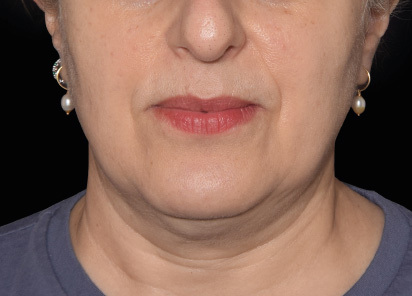 Emface_PIC_035-After-jawline-female-Yael-Halaas-MD-4TX_412x296px_1663831266_original