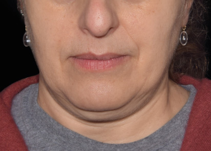 Emface_PIC_035-Before-jawline-female-Yael-Halaas-MD_412x296px_1663831266_original