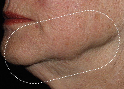 Emface_PIC_042-After-jawline-female-Richar-Gentile-MD-1M-AL_412x296px_1663831267_original