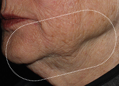 Emface_PIC_042-Before-jawline-female-Richar-Gentile-MD_412x296px_1663831267_original