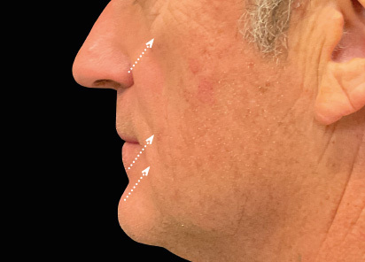 Emface_PIC_047-After-face-male-Charles-Boyd-MD-3M-4TX_412x296px_1663831022_original