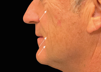 Emface_PIC_047-Before-face-male-Charles-Boyd-MD_412x296px_1663831023_original