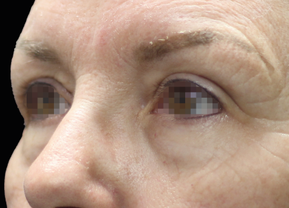 Emface_PIC_051-After-eyes-female-Joel-L-Cohen-MD-4TX_101_412x296px_1672384152_original