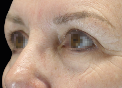 Emface_PIC_051-Before-eyes-female-Joel-L-Cohen-MD_101_412x296px_1672384135_original