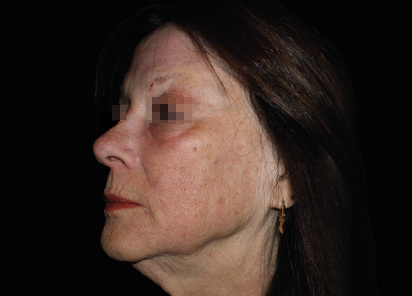 Emface_PIC_052-After-face-female-Richar-Gentile-MD-1M-AL_412x296px_1664798060_original_v2_1748260023_original