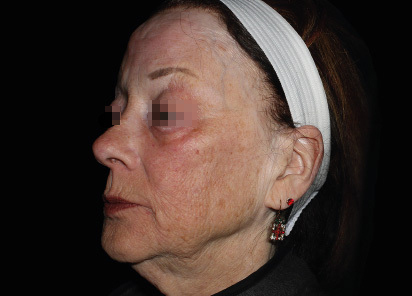 Emface_PIC_052-Before-face-female-Richar-Gentile-MD_412x296px_1664798061_original_v2_1748259996_original