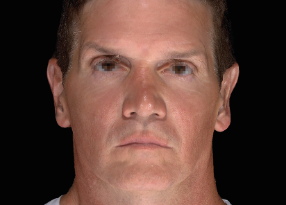 Emface_PIC_053-After-face-male-Charles-Boyd-MD-4TX_101_412x296px_1672384061_original