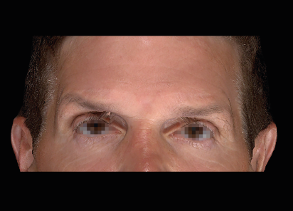 Emface_PIC_053-After-face-male-Charles-Boyd-MD-4TX_101_412x296px_1_1672384329_original