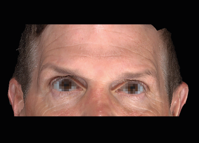 Emface_PIC_053-Before-face-male-Charles-Boyd-MD_101_412x296px_1_1672384315_original