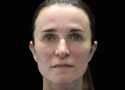 Emface_PIC_057-After-face-female-Joel-L-Cohen-MD4TX_101_412x296px_1672383887_original