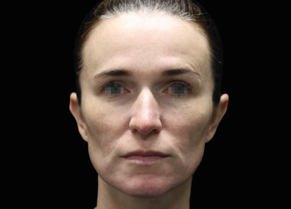 Emface_PIC_057-Before-face-female-Joel-L-Cohen-MD_101_412x296px_1672383853_original