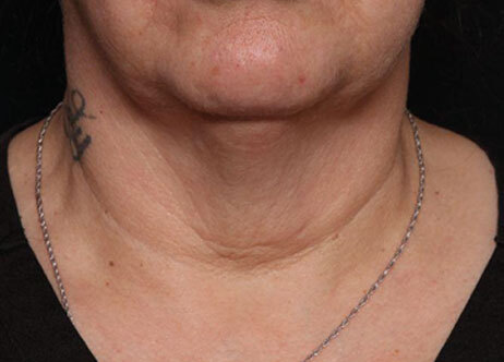 Emface_PIC_Ba-003-card-female-before-submentum_ENAU100_1711633322_original