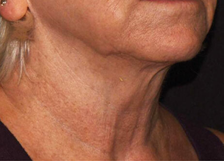 Emface_PIC_Ba-006-card-female-after-submentum_ENAU100_1711633323_original