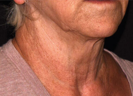 Emface_PIC_Ba-006-card-female-before-submentum_ENAU100_1711633323_original