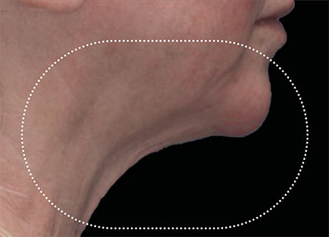 Emface_PIC_Ba-049-card-female-after-submentum_ENAU100_1711633324_original