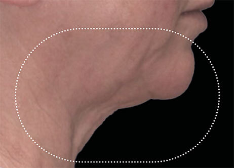 Emface_PIC_Ba-049-card-female-before-submentum_ENAU100_1711633324_original