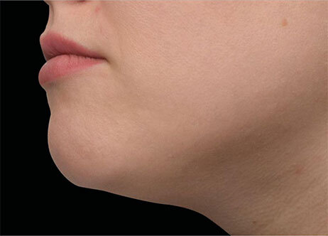 Emface_PIC_Ba-110-card-female-after-submentum_ENAU100_1711633324_original