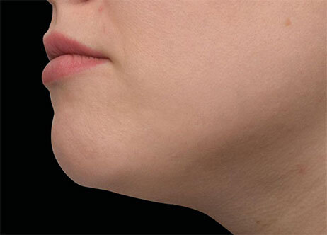 Emface_PIC_Ba-110-card-female-after-submentum_ENUS100_1706022453_original