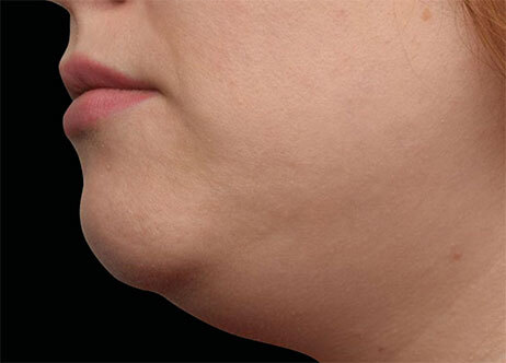 Emface_PIC_Ba-110-card-female-before-submentum_ENAU100_1711633325_original