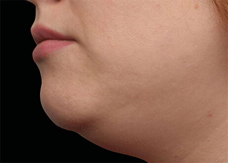 Emface_PIC_Ba-110-card-female-before-submentum_ENUS100_1706022454_original