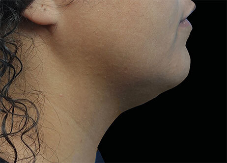 Emface_PIC_Ba-111-card-female-after-submentum_ENUS100_1706022454_original