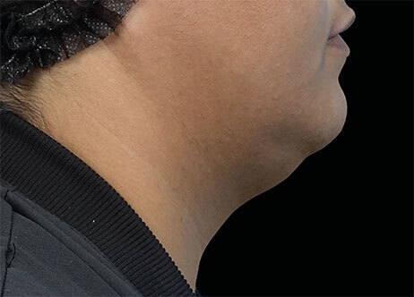 Emface_PIC_Ba-111-card-female-before-submentum_ENUS100_1706022455_original